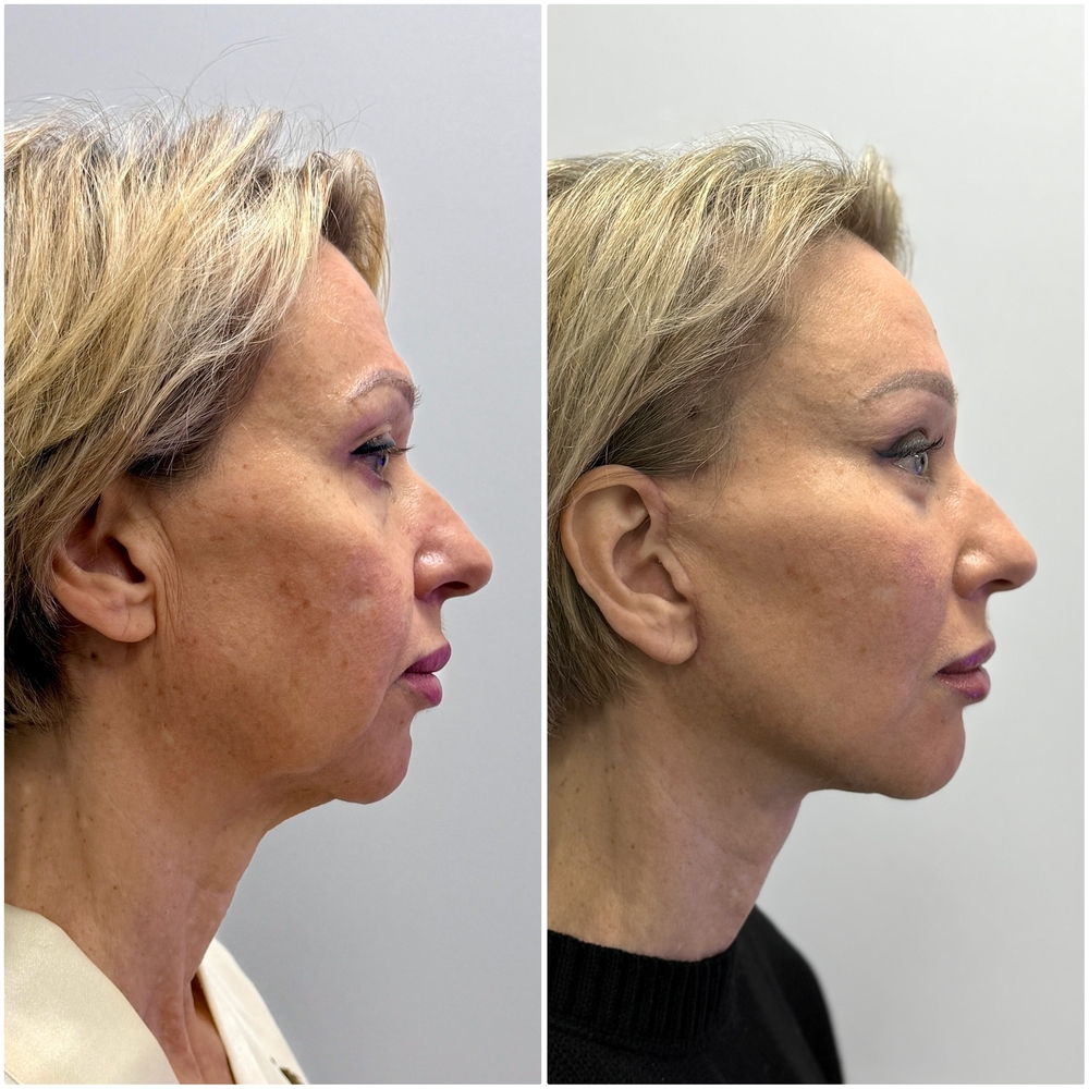 Периорбитопластика фото до после